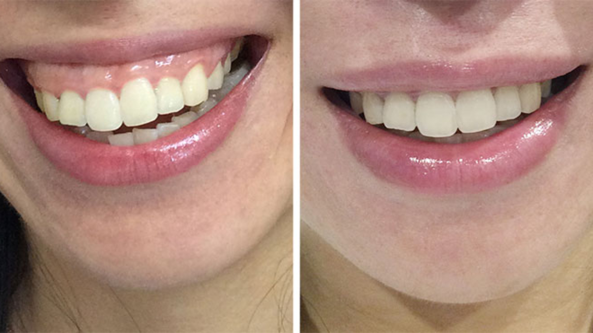 Gummy-Smile-Botox